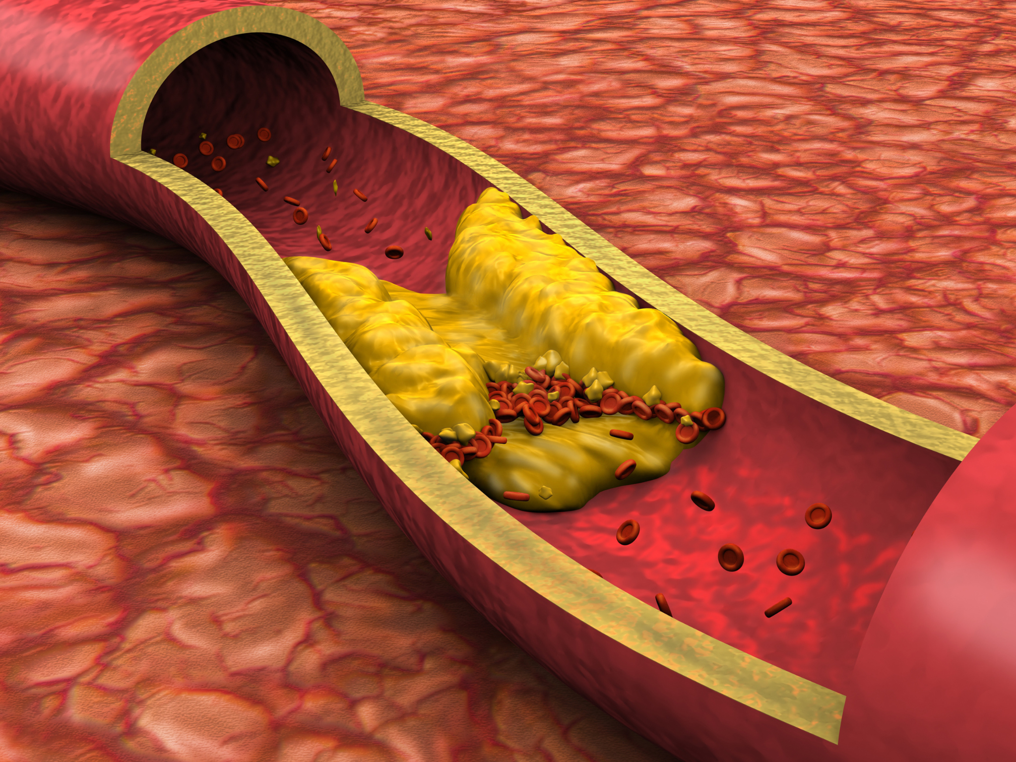 8 signalen dat je een hoog cholesterol hebt