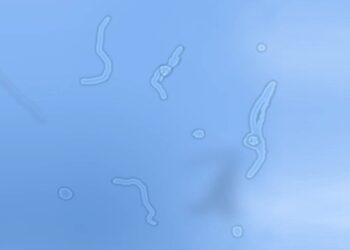 Zie jij ook ‘floaters’ in je ogen? Dít is wat er écht aan de hand is…